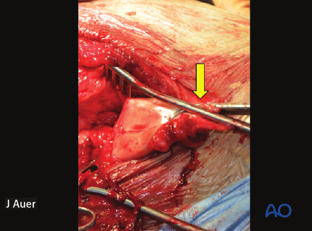 shoulder arthrodesis