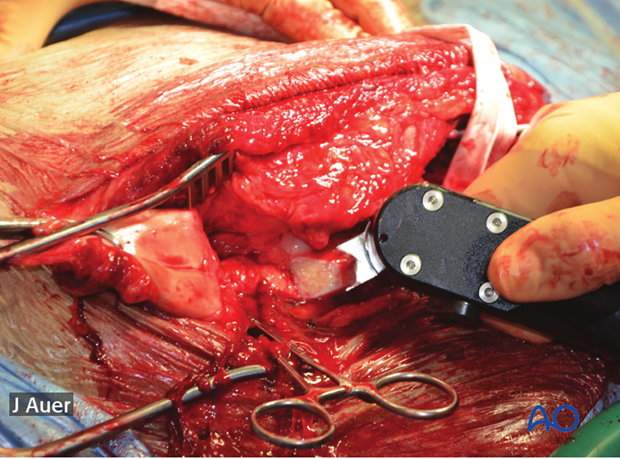 shoulder arthrodesis