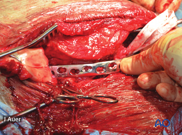 shoulder arthrodesis