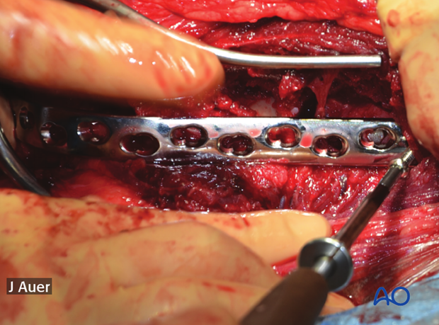 shoulder arthrodesis