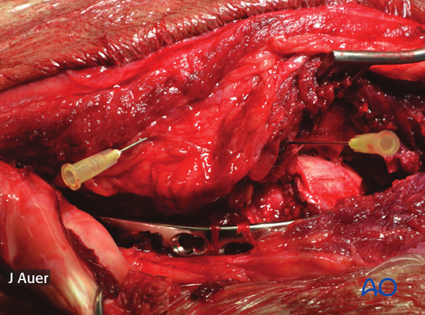 shoulder arthrodesis