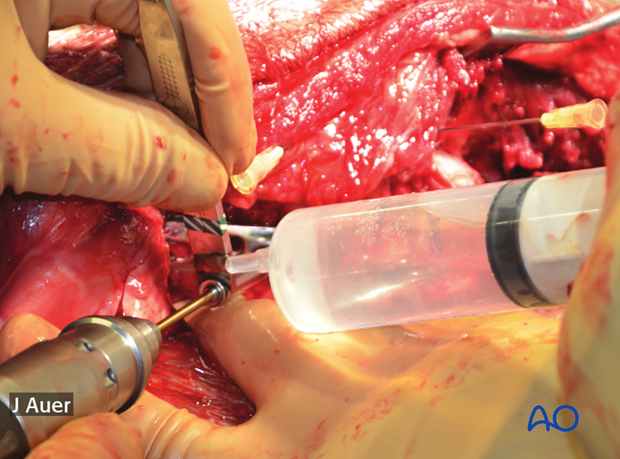 shoulder arthrodesis