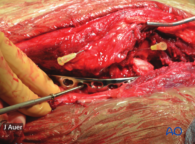 shoulder arthrodesis