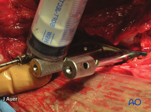shoulder arthrodesis