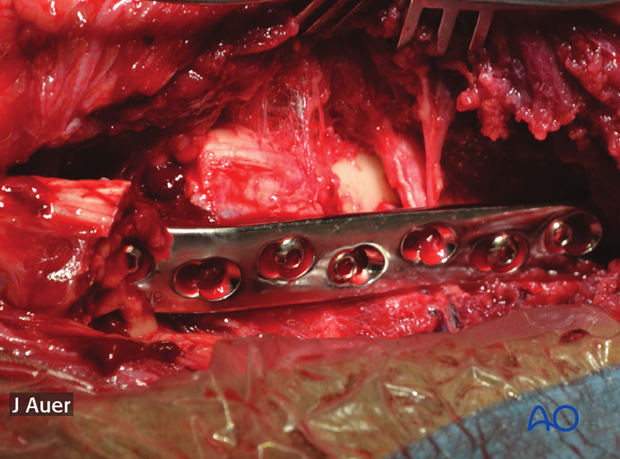shoulder arthrodesis