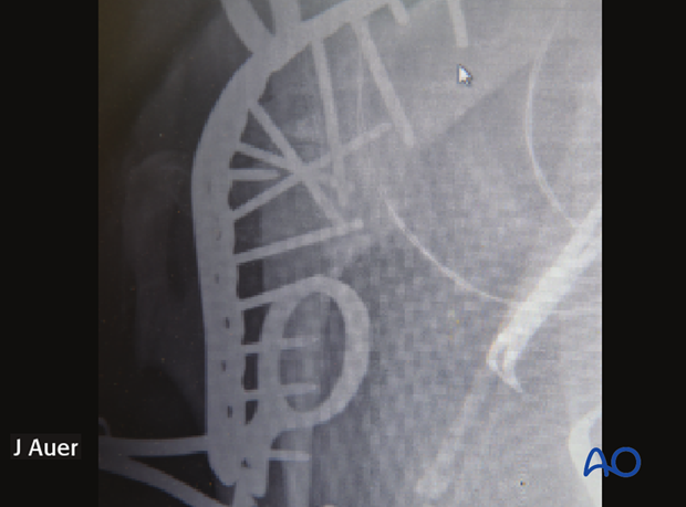 shoulder arthrodesis