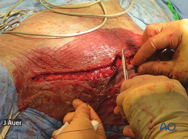 shoulder arthrodesis