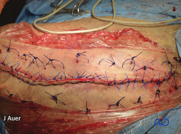 shoulder arthrodesis
