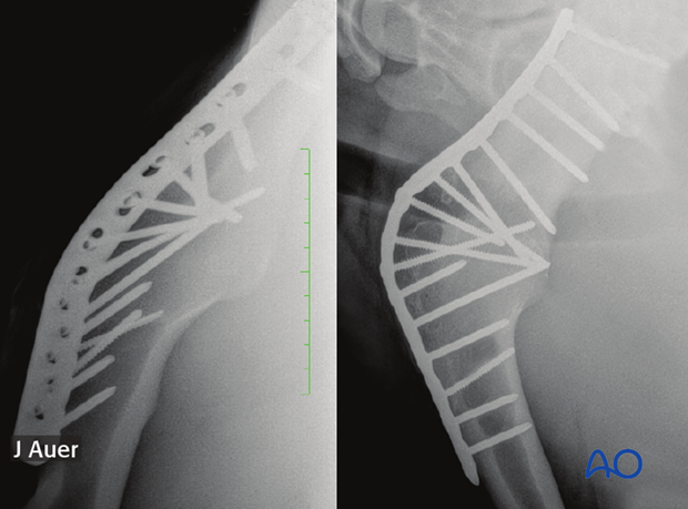 shoulder arthrodesis