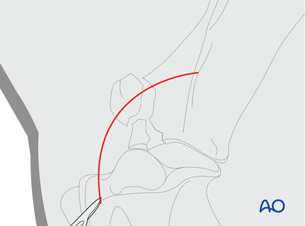 long craniolateral approach to the shoulder