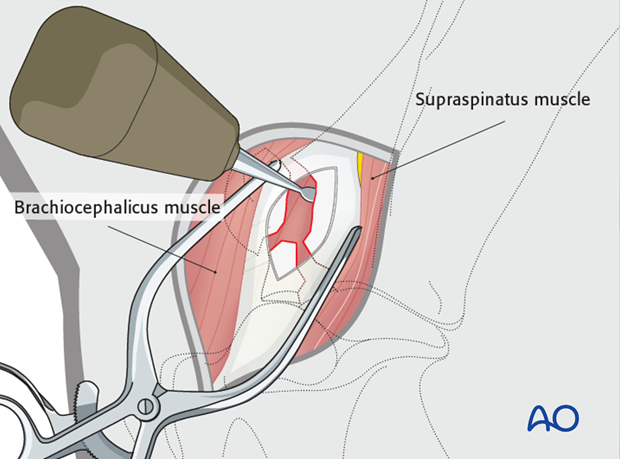 craniolateral approach to the shoulder