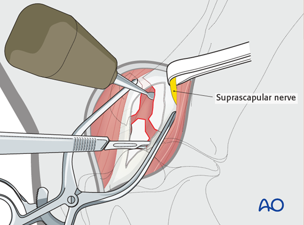craniolateral approach to the shoulder