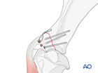 supraglenoid tubercle