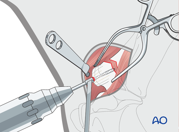 screw fixation