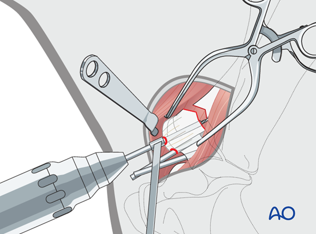 screw fixation