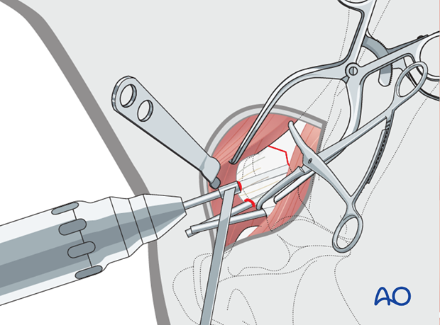 screw fixation