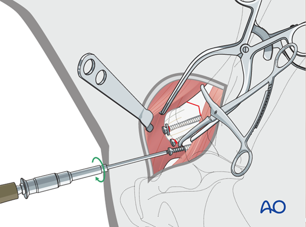 screw fixation
