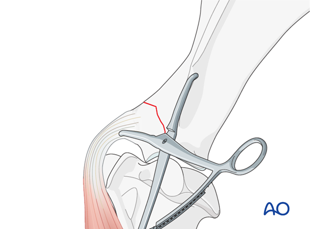screw fixation