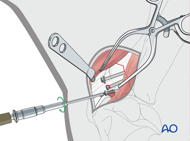 screw fixation