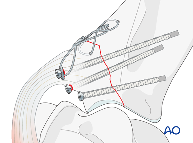 screw fixation