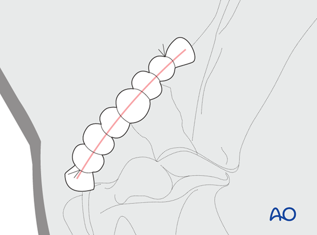 screw fixation