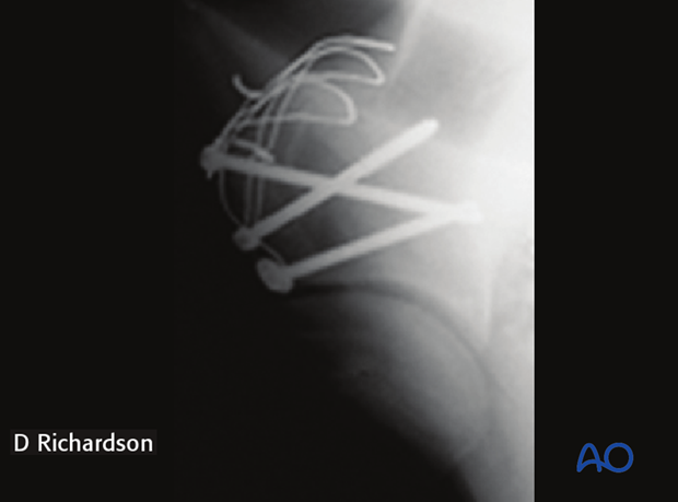 screw fixation