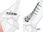 supraglenoid tubercle