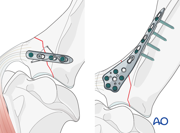 supraglenoid tubercle