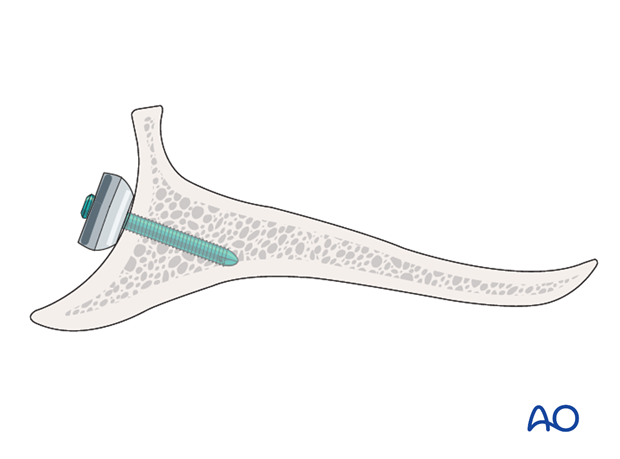 plate fixation