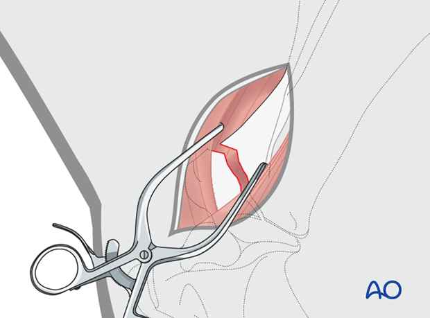 long craniolateral approach to the shoulder