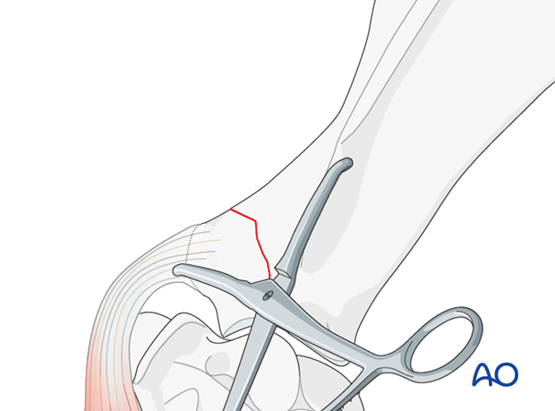 plate fixation