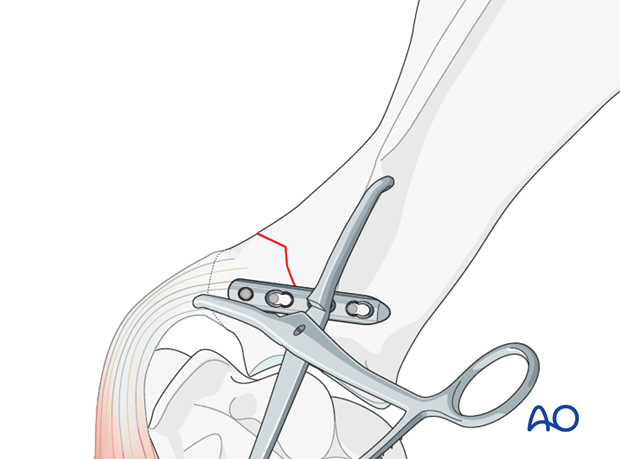 plate fixation