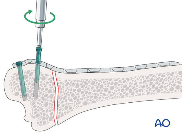 plate fixation
