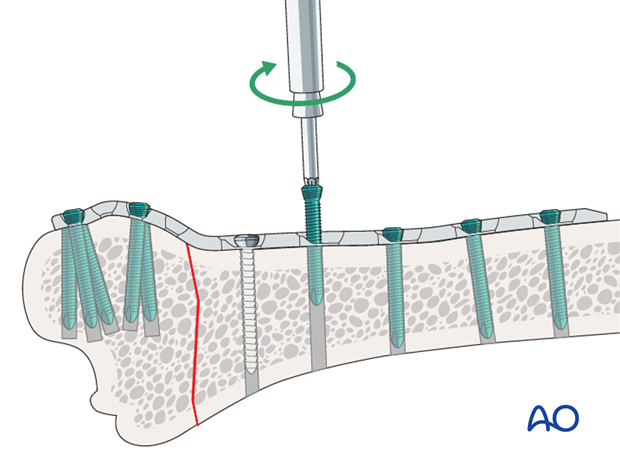 plate fixation