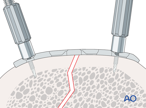 plate fixation