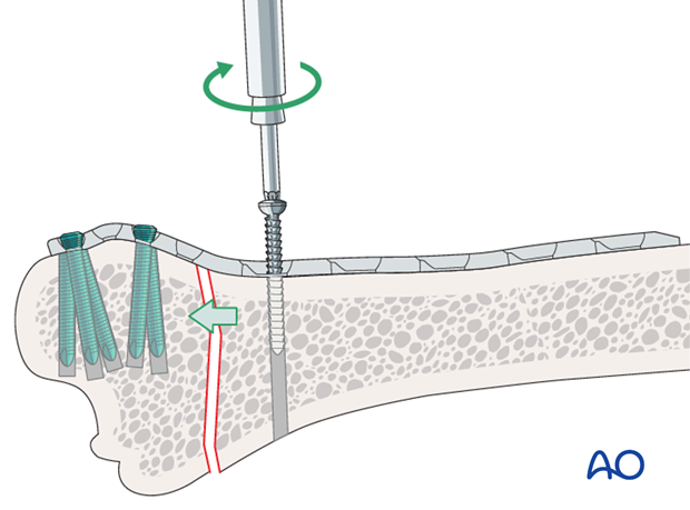 plate fixation