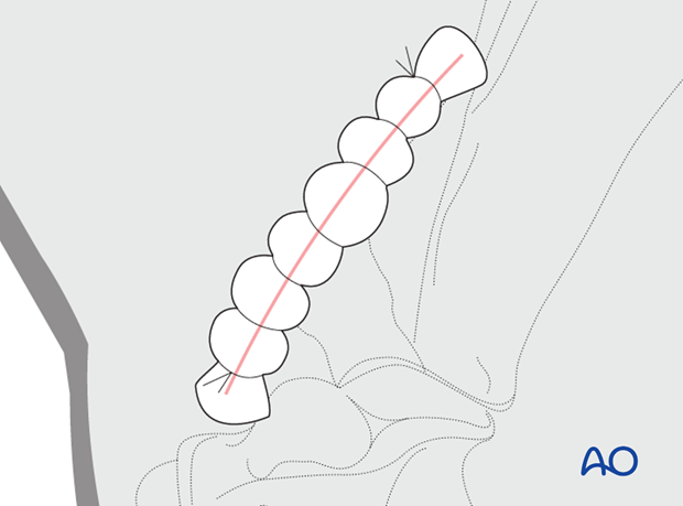 plate fixation