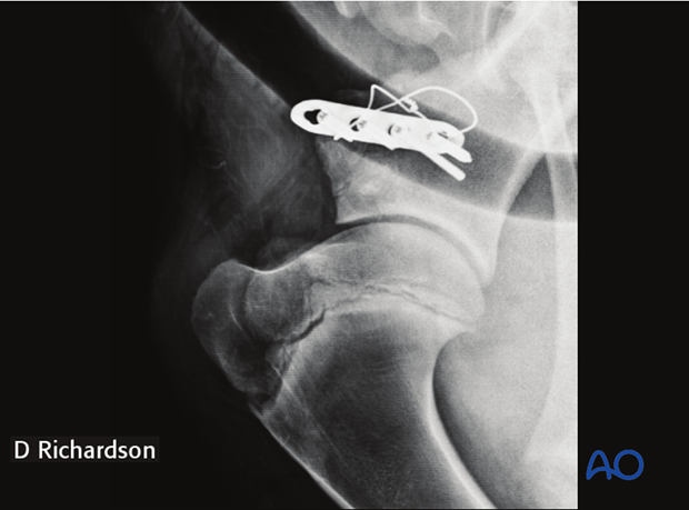 plate fixation
