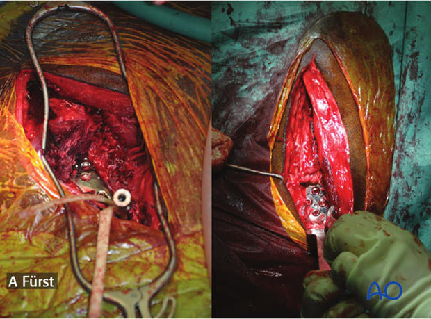 plate fixation