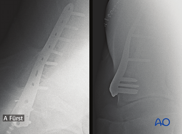 plate fixation