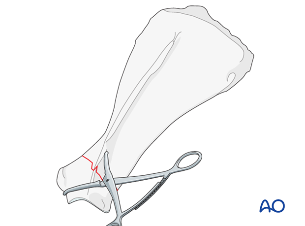 plate fixation