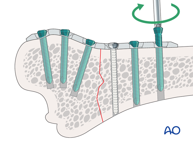 plate fixation