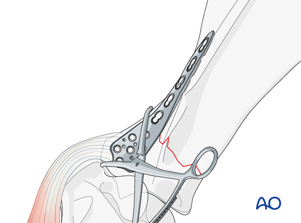 plate fixation