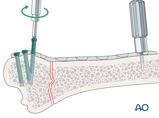 plate fixation