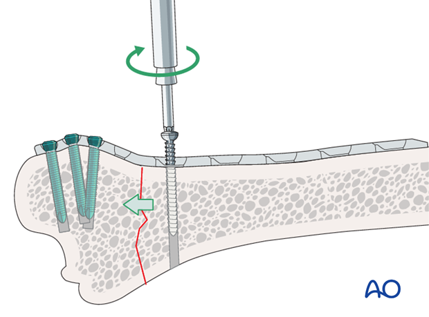 plate fixation