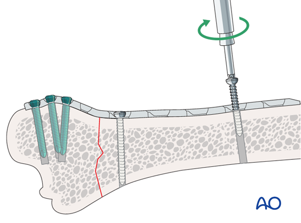 plate fixation