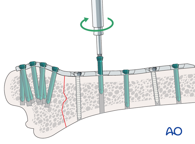 plate fixation