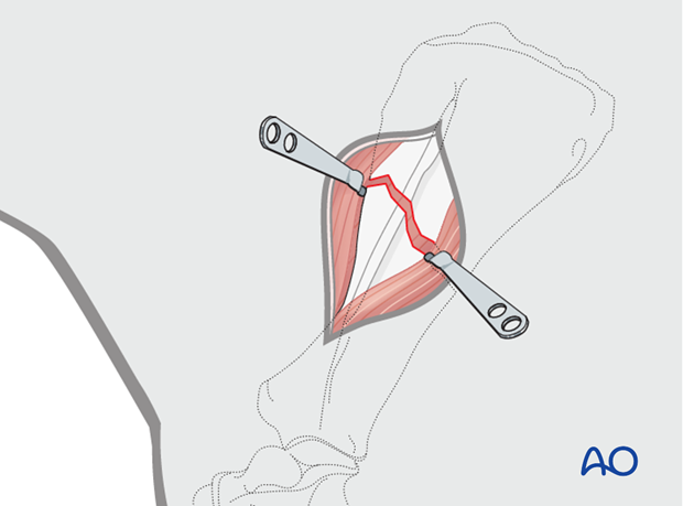 lateral approach to the scapula