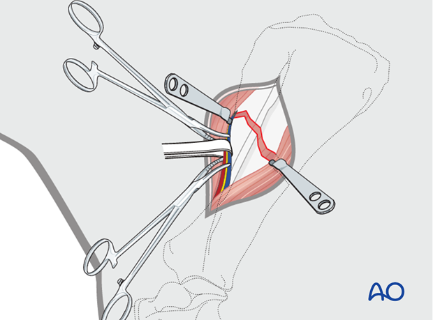 lateral approach to the scapula