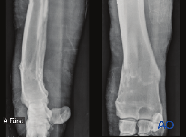 nonsurgical fracture management